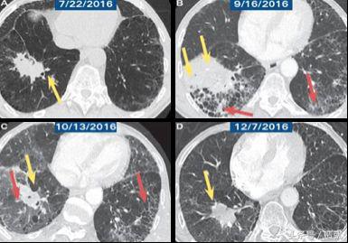 7种常见癌症的早期发现和预防,癌症是可以预防的癌症真相大揭秘