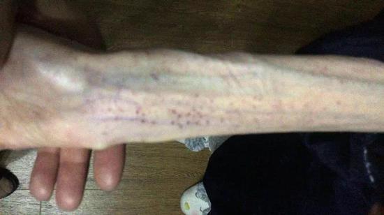 21岁女孩自杀式减肥只剩50斤照片不忍直视