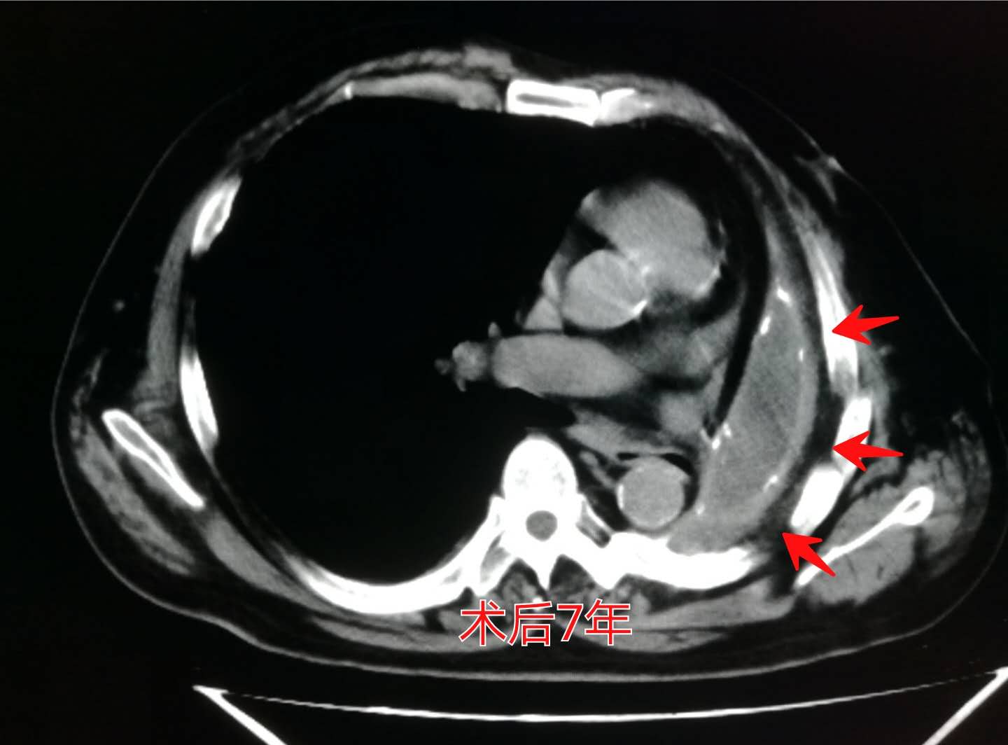 肺癌手术后胸腔内有碎肉怎么办,肺癌切除手术后有个空腔