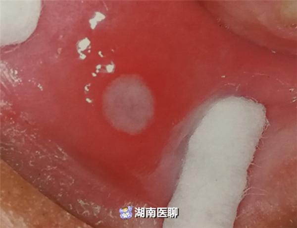 癌性口腔溃疡和普通溃疡区别,口腔溃疡反复发作是什么原因呢