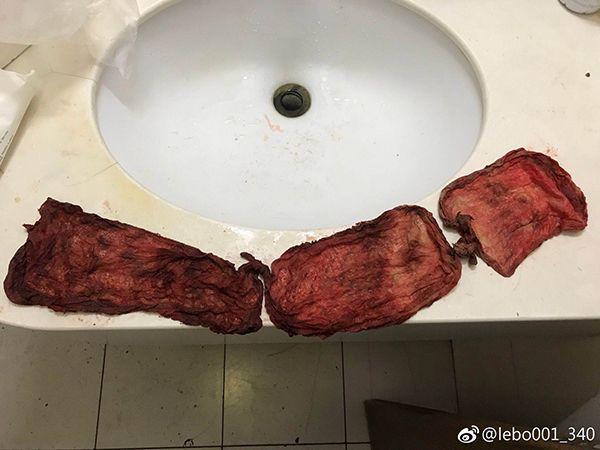 北大妇产科剖腹产,北大人民医院剖腹产