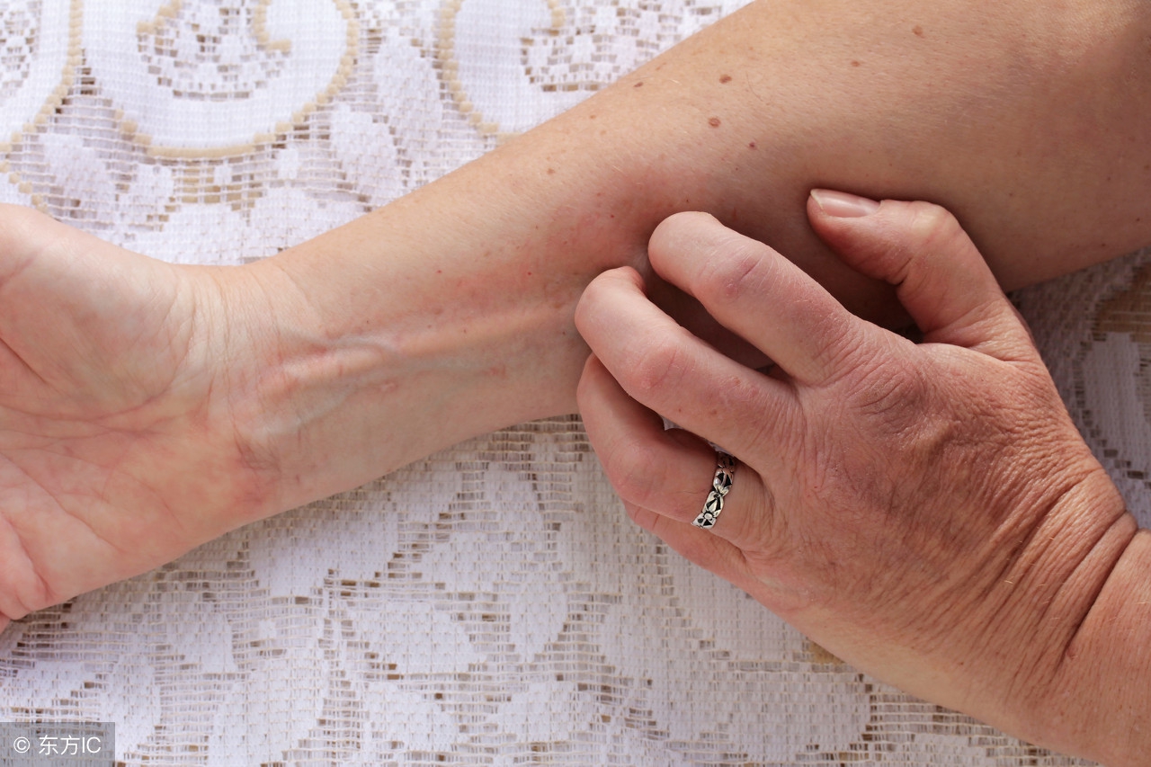 山药是发物吗湿疹患者能吃吗,湿疹患者可以吃芹菜吗