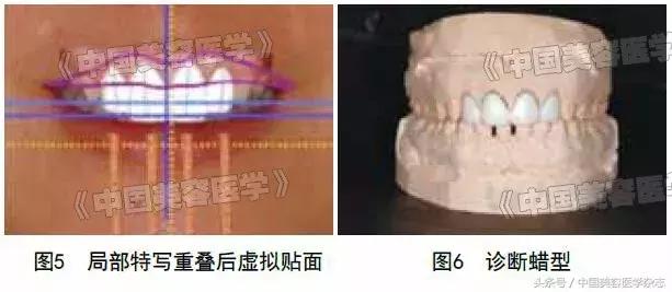 牙齿缝隙太大怎么补救吃什么,牙齿缝隙太大怎么快速补救