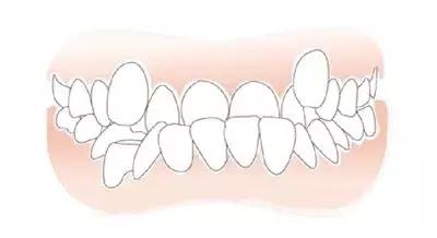 吃饭总是咬舌头的真相,老是咬舌头想吃肉怎么回事