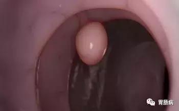 肠息肉切除还是不切除,肠息肉和胆囊息肉必须做手术吗