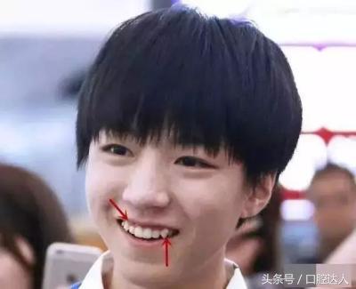 隐形牙套佩戴注意事项,替牙期隐形牙套佩戴管理