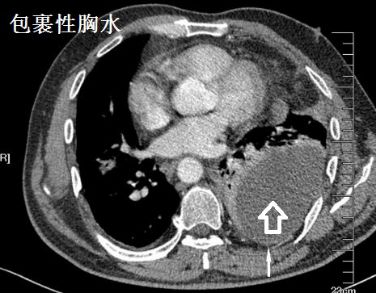 胸水为什么会抽不到,胸水抽了为什么还呼吸困难