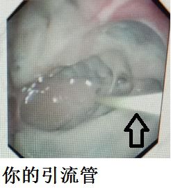 胸水抽了为什么还呼吸困难,胸水抽不出来了怎么回事