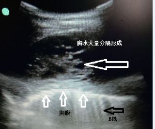 胸水为什么会抽不到,胸水抽了为什么还呼吸困难