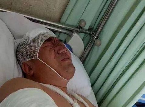 头部轻微外伤怎么处理,儿童头部外伤处理