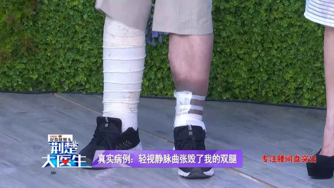 腿部网状静脉曲张的最快消除方法,怎样治静脉曲张和蚯蚓腿