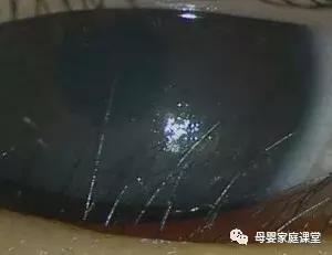 宝宝眼屎多是上火吗,白眼屎是寒气还是上火