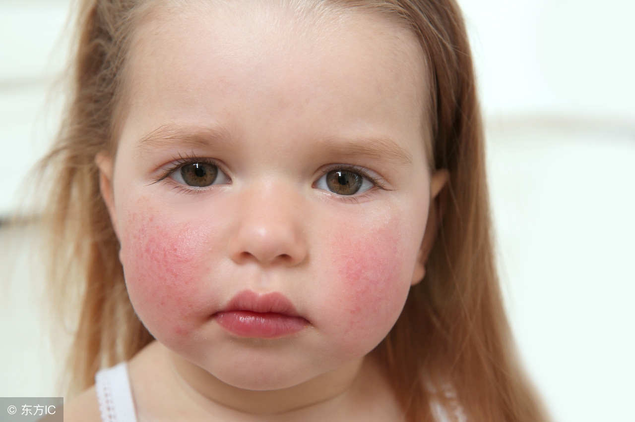 虾蟹过敏会遗传吗,怀孕吃虾过敏