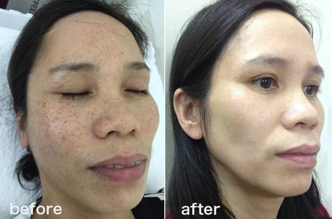 坚持7天的细纹消失,没有细纹但是有斑点