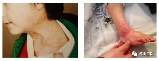 疤痕没那么可怕找对方法即可淡疤,有疤痕的你还在为疤痕烦恼吗