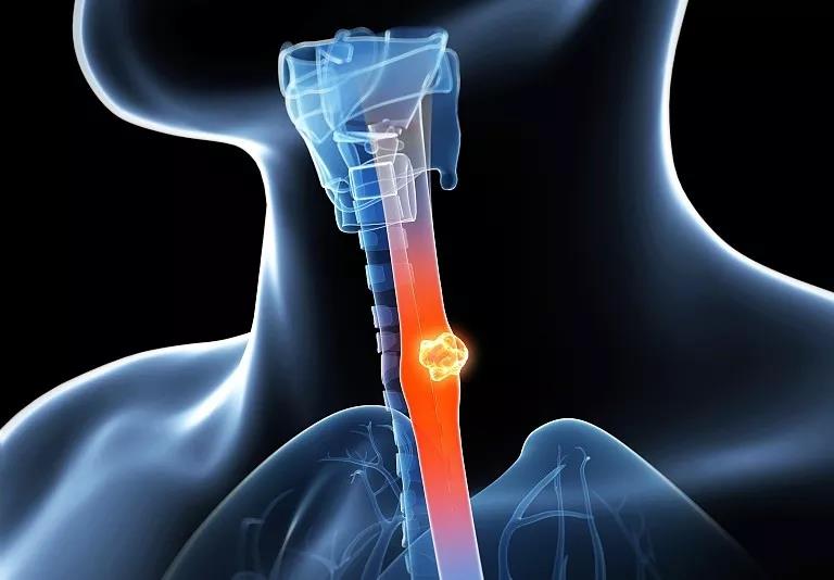 食道癌患者亲身经历,重度食道癌的三大坏习惯