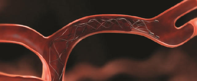 急性脑梗塞治疗指南pdf,急性脑梗塞介入取栓治疗有风险吗