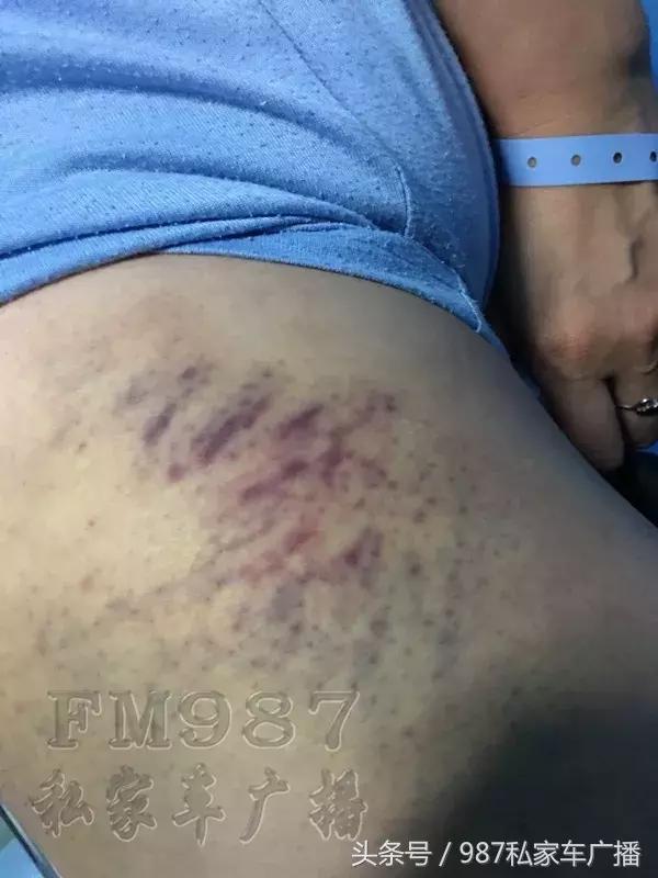 合肥滴滴顺风车事故拒赔 (福州滴滴网约车凌晨两点发生事故)