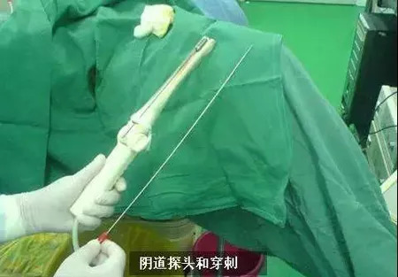 女孩捐卵被骗案例,捐卵子骗局案例