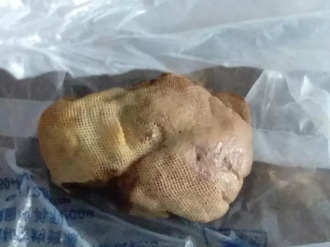 人流后十天剧烈腹痛排出肉样物,女生流产手术后小肚子大