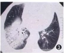 每日咳嗽是什么原因,每日咳痰