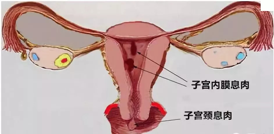 肠息肉和胆囊息肉必须做手术吗,肠息肉切除好还是不切除好