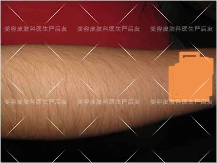 上海面部激光脱毛,正确认识皮肤