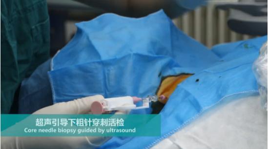 微波消融术，让甲状腺患者康复“加速度”