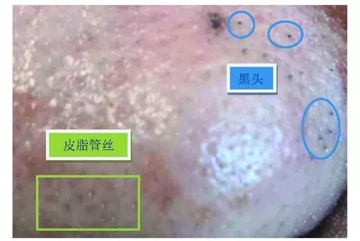 在家用黑头鼻贴去黑头的有效方法,去黑头鼻贴可以真正消灭黑头吗
