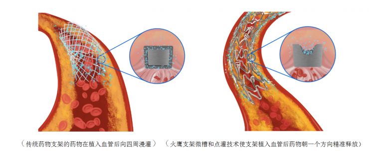 火鹰之后还有火鹮中国智造医疗器械海外突围