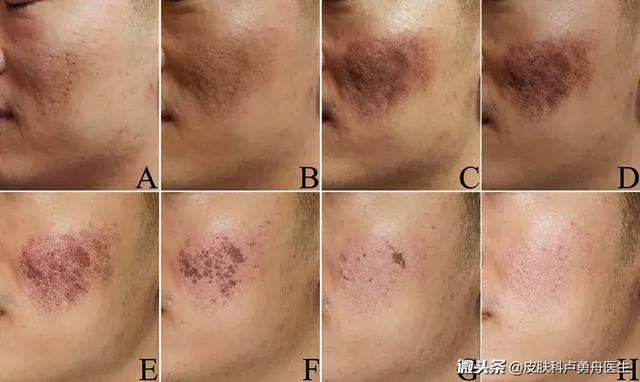 抗痘印护肤流程,抗痘药膏怎么涂