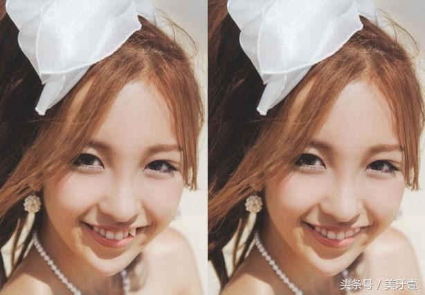 畸形牙怎么处理要拔牙吗,畸形老虎牙矫正可以磨吗