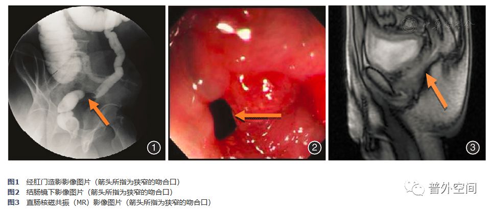 直肠癌新辅助治疗术后病理解读,直肠癌局部切除的手术适应症