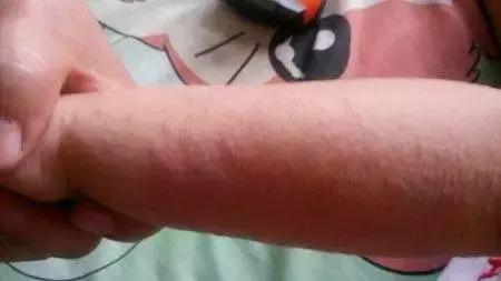 宝宝湿疹终于好了,宝宝湿疹治愈经历