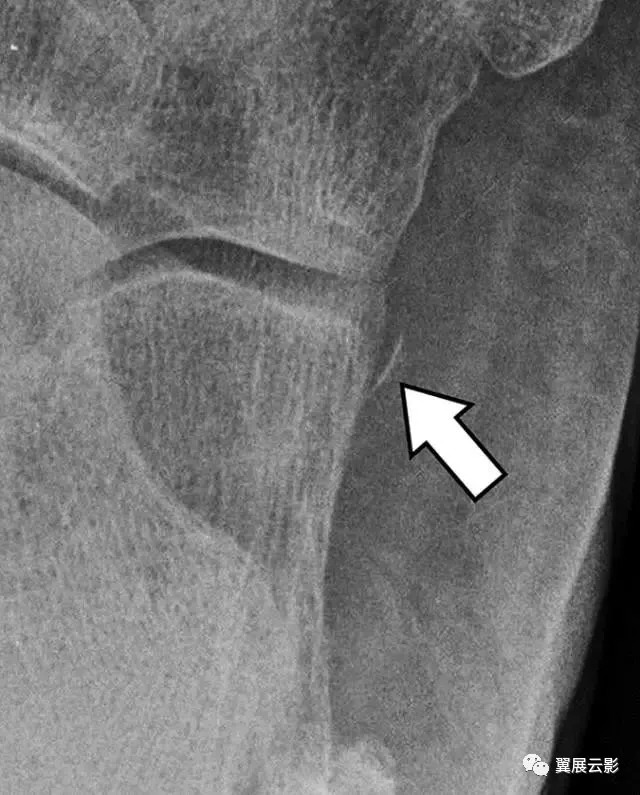轻微骨裂容易被误诊,临床容易误诊的影像片子
