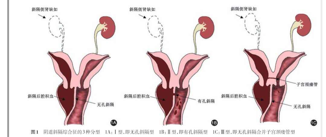 女子痛经20年罪魁祸首竟是此病,16岁痛经3年是什么原因造成的