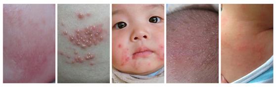 婴儿肌肤总有问题,远离宝宝肌肤问题