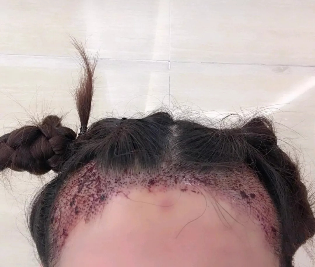 修理发际线男士,男生要不要修发际线