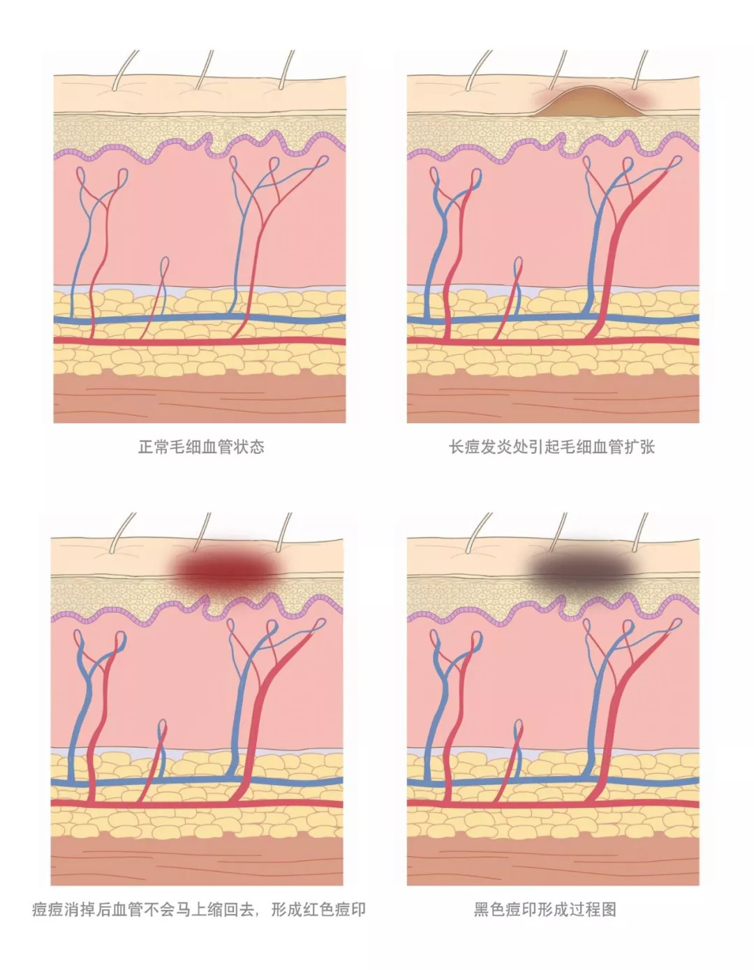 30天花80块去掉陈年老痘印到底有没有可能？