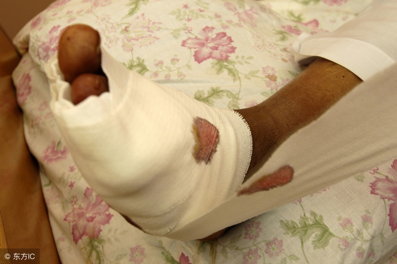 糖尿病患者病足溃破,糖尿病足溃烂截肢后可以恢复吗