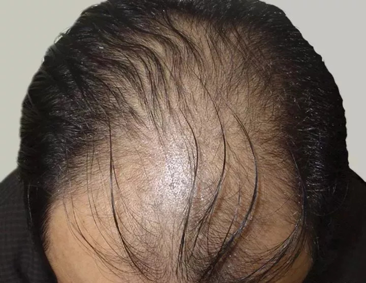 脱发千万别轻信偏方医生告诉你,你还在脱发吗