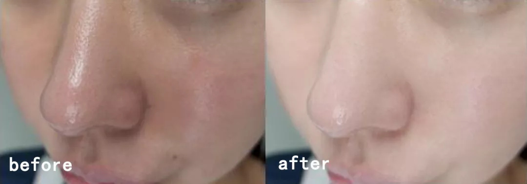 脱发算啥!90后已经开始长“老年斑”了,有人还为此花了10多万!