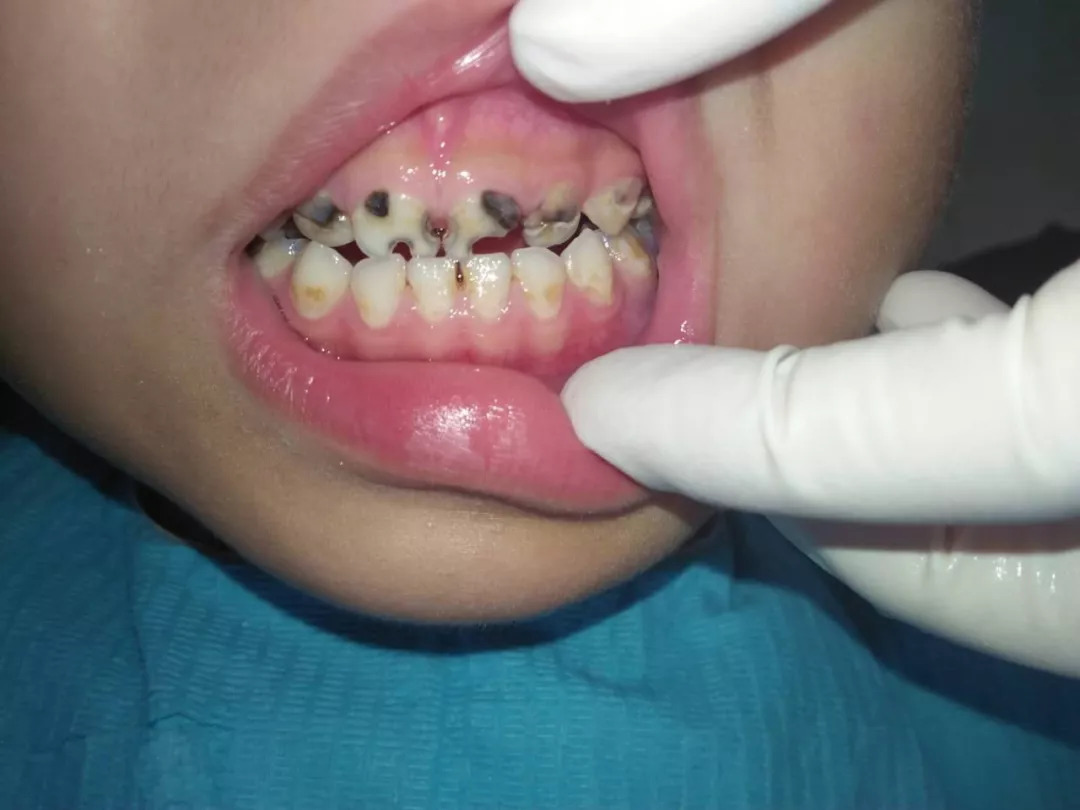 小孩蛀牙影响到牙神经了怎么办,儿童蛀牙疼痛可以杀死牙神经吗