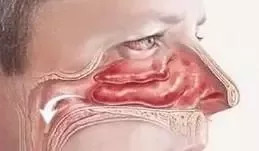 儿童好用的鼻炎喷剂,日本儿童鼻炎喷雾药