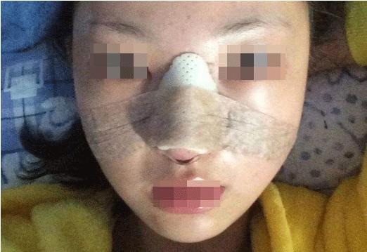 为什么有的人隆鼻成功有的失败,揭秘医生都不会说的隆鼻内幕