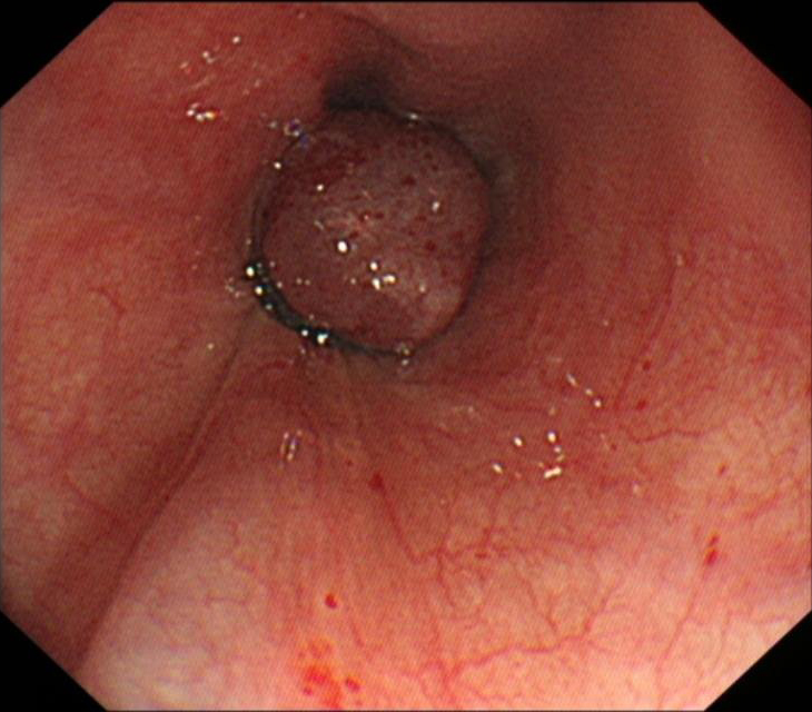 肝硬化中西医结合治疗并发症,肝硬化tips介入手术并发症