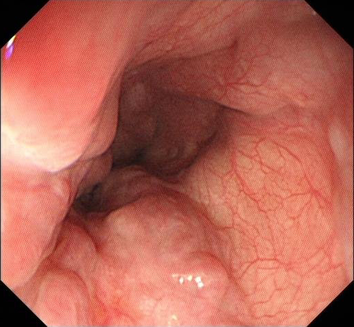 肝硬化中西医结合治疗并发症,肝硬化tips介入手术并发症