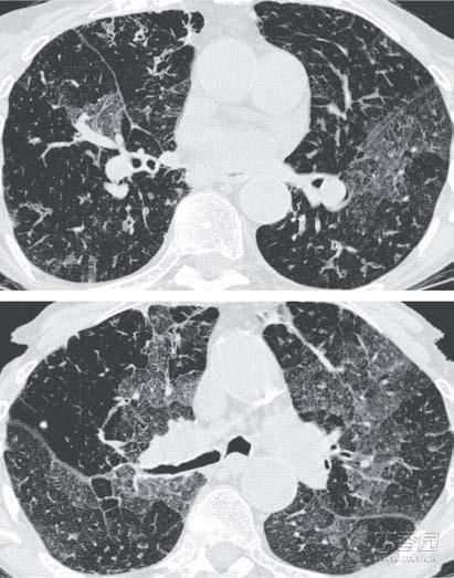 它比香烟毒7倍,国外已被禁,很多中国人却还在用!最新研究:它会导致基因变异,引起肺癌!