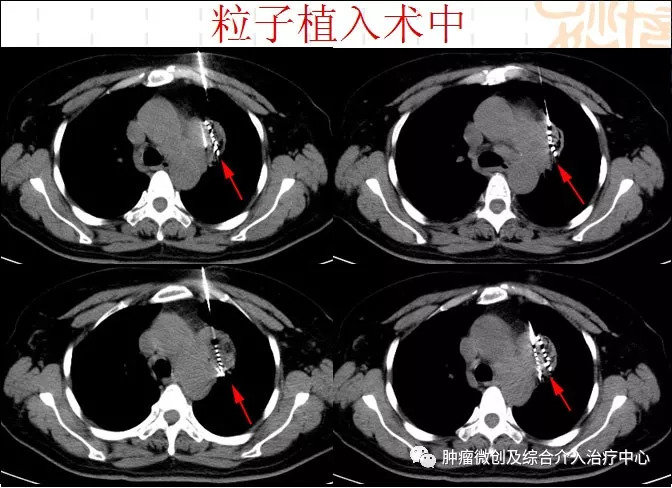 肺癌的诊断+综合介入治疗（穿刺活检+肿瘤血管栓塞+消融+碘125例子植入）—运城市第一医院肿瘤微创及综合介入科