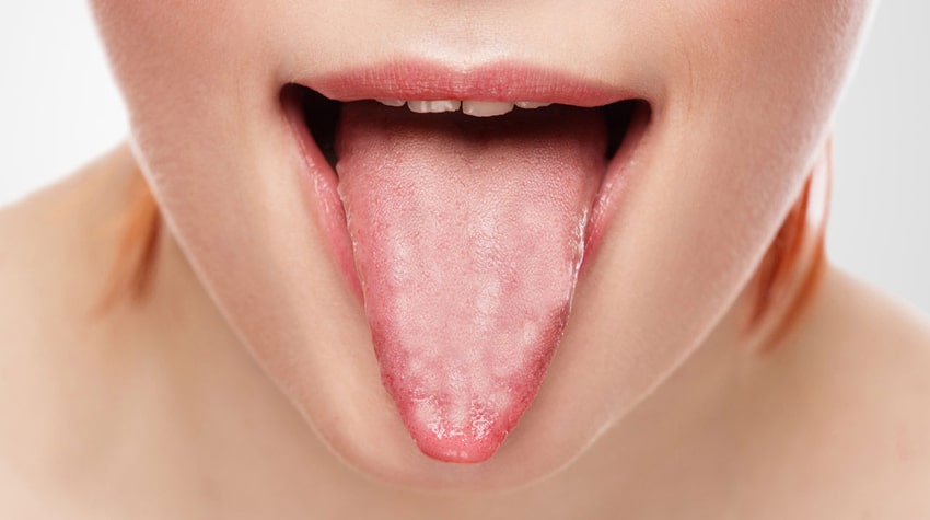 没有舌苔啥毛病,没有舌苔是哪里不健康